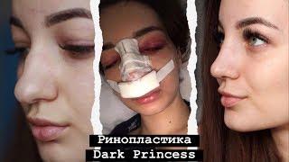 РИНОПЛАСТИКА DARK PRINCESS  одна в Ереване  ДО и ПОСЛЕ