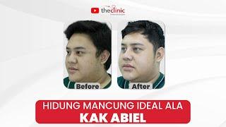 TIPS HIDUNG MANCUNG NATURAL KAK ABIEL  Rhinoplasty  #Bedahplastik