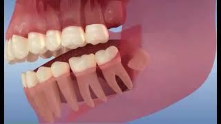 ÉVOLUTION des dents de SAGESSE