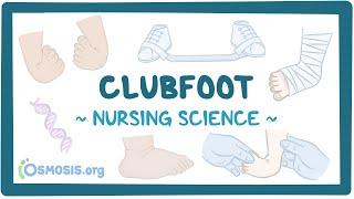 Clubfoot Clinical Nursing Care