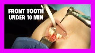 Front Tooth Implant Surgery - Enroll in Our DETAILED ONLINE COURSE