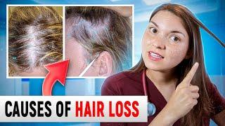 What HAIR LOSS Says About Your HEALTH Top 15 Causes of Hair Loss Doctor Explains