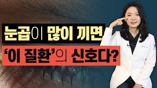 눈 건강의 바로미터 눈곱 눈곱의 형태로 눈 건강을 알 수 있다? - 아이조아 #140