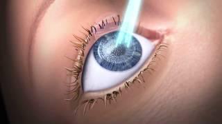 Features of SCHWIND AMARIS Excimer Laser for refractive surgery laser treatments