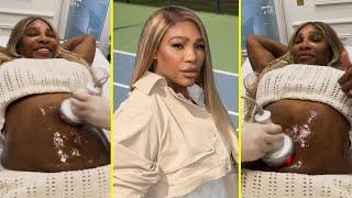 Serena Williams Reveals Her Stunning Skin-Tightening Tummy Procedure After Baby Birth