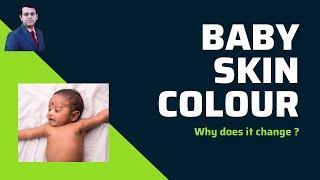 Baby Skin Colour  Why does it Change ?