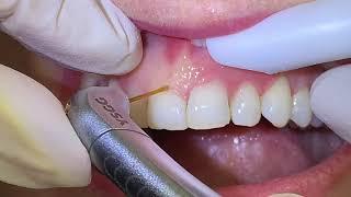 Houston Cosmetic Dentist...Uneven gums? Amazing laser procedure to create more symmetrical teeth