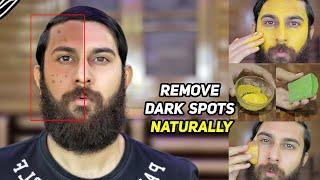 6 WAYS TO REMOVE DARK SPOTS  Black Spots Hyper Pigmentation & Acne Scars  Home Remedies