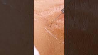 Up close view of how laser stretch mark removal works  #shorts