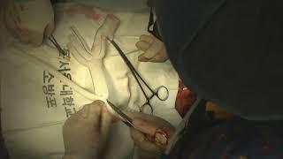 Asvide Replacement of Crawford type II thoracoabdominal aortic aneurysm using a branched graft ...