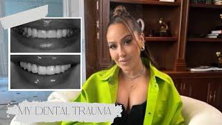 My Dental Trauma Before & After Veneers