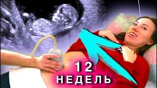 УВИДЕЛИ МАЛЫША - Мальчик ИЛИ Девочка ? Третье УЗИ 12 Недель 1 Скрининг - Я БЕРЕМЕННА  Elli Di