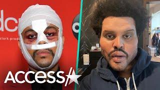 The Weeknd Finally Explains Face Bandages