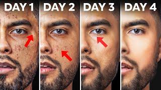 How To Fix Your Skin in 4 Days  Use At Home Products