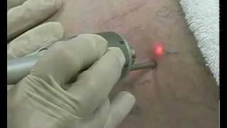 Coral Spas Laser Spider Vein Removal - Legs