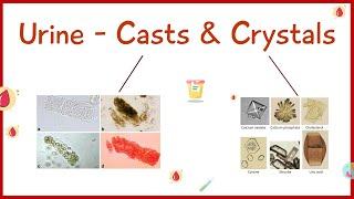 Urine examination - Casts & crystals  Microscopic examination of Urine  Hindi  By Madhukar Sir