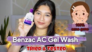 Benzoyl peroxide face wash - Benzac AC Gel wash  Best cleanser for acne  Catalytic Akanshya