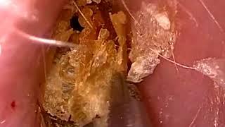 Ear wax removel video 2  rakul g  booger video