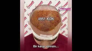 4951 Greft 2 seans saç ekimi 6 ay öncesi sonrası hairtransplant haartransplant Konya Türkiye