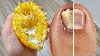 Nail Fungus Removal 100% Natural Treatment For Toenail Fungus