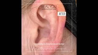 Ear Lump removal - Instagram Clip - Real You Clinic
