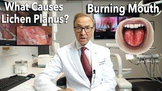 Lichen Planus - Burning Mouth Symptoms  Causes  Treatment