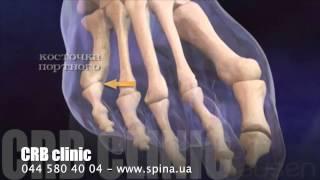 Косточка на ноге. Hallux Valgus. Как появляются косточки на ногах?