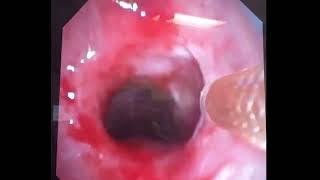 Asvide Endobronchial treatment of tracheal stenosis using spray cryotherapy micro …