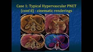 Typical and Atypical Appearances of PNETs Role of CTA and Cinematic Rendering - Part 1