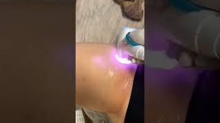 Say Goodbye to Unwanted Leg Hair Laser Hair Removal Solutions #beauty #skincare #shorts