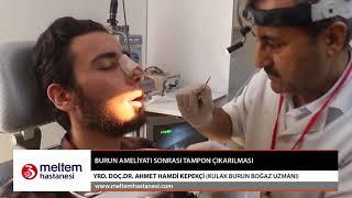 Burun Ameliyatı Sonrası Tampon Çıkarılması-Yrd. Doc. Dr. Ahmet Hamdi Kepekçi