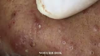 Popping Tons Of Blackheads Part 192