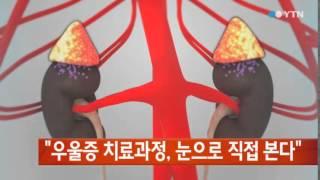 우울증 치료과정 눈으로 직접 본다  YTN