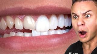 Her Veneers RUINED Her Life Heres Why...