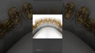 Lingual Golden Braces Dental Procedure