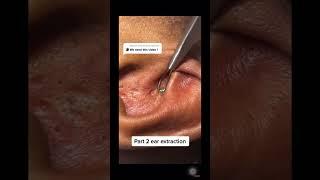 Ear extraction #extraction #galaxyextractions #drpimplepopper #oddlysatisfying