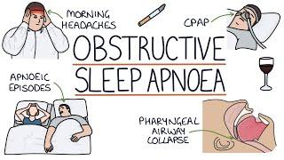 Obstructive Sleep Apnoea