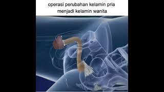 Proses Operasi Perubahan Kelamin pada Manusia #viral #medical #medis #bedah #operasi