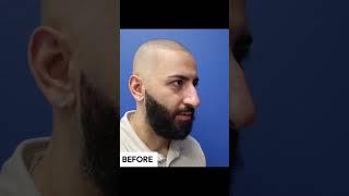 Liquid Rhinoplasty Before And After  Avance Plastic Surgery Dr. Erez Dayan  Reno Tahoe NV