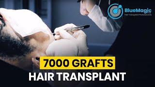 FUE Sapphire Hair Transplant Istanbul  7000 Grafts Hair Transplant  BlueMagic Group International