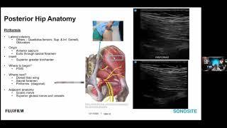 Webinar Examining Hip Anatomy and Structure with POCUS - Posterior Hip