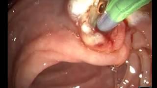 Choledocholithiasis -Sphincterotomy and Stone Removal With an Extraction Balloon