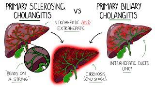 Primary Sclerosing Cholangitis v Primary Biliary Cholangitis Primary Biliary Cirrhosis