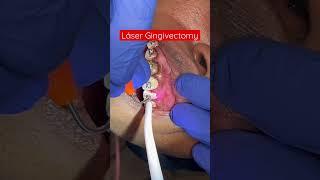 Laser Gum Removal