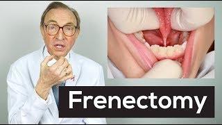 What is a Frenectomy?