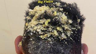 DRY SCALP  Big Flakes Dandruff Scratching Satisfying Video #807