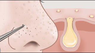 Remove the sebum with tweezers Visually SATISFYING animation  LULUPANG