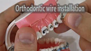 How to install & ligate orthodontic wire with elastic ligature and ss twisted preformed ligature