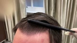 Hair Transplant Results