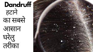 डैंड्रफ हटाने का सबसे आसान घरेलु तरीका  How to Treat Dandruff at Home  Sunitasrecipe